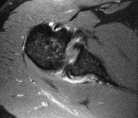 Figure 2 for case Reverse bankart and hill sachs lesions